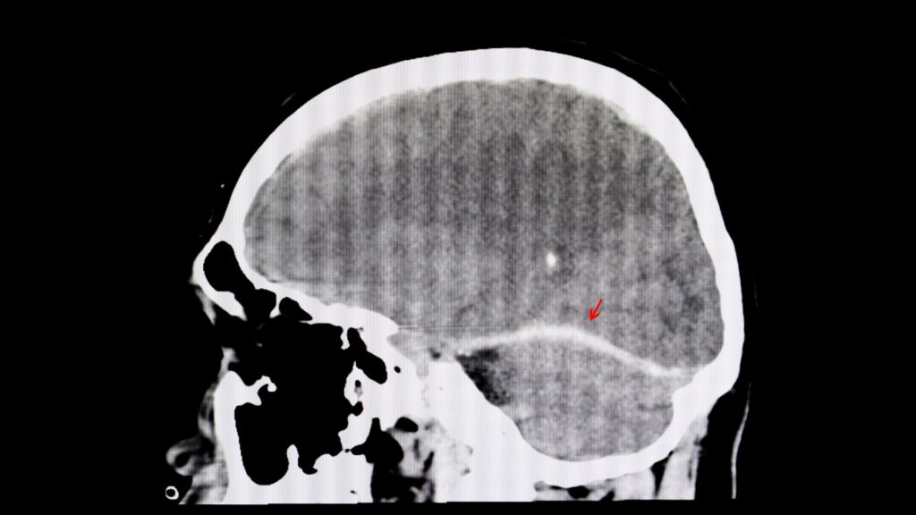 When Should You Contact a Traumatic Brain Injury Attorney in California After an Accident Image